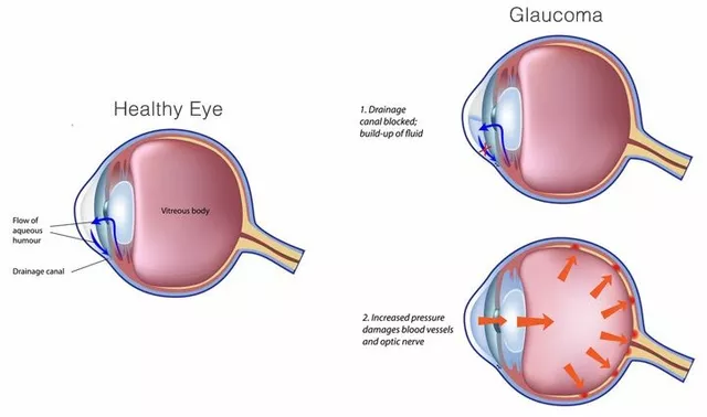 How to Prevent Ocular Hypertension: Tips for Maintaining Healthy Eyes